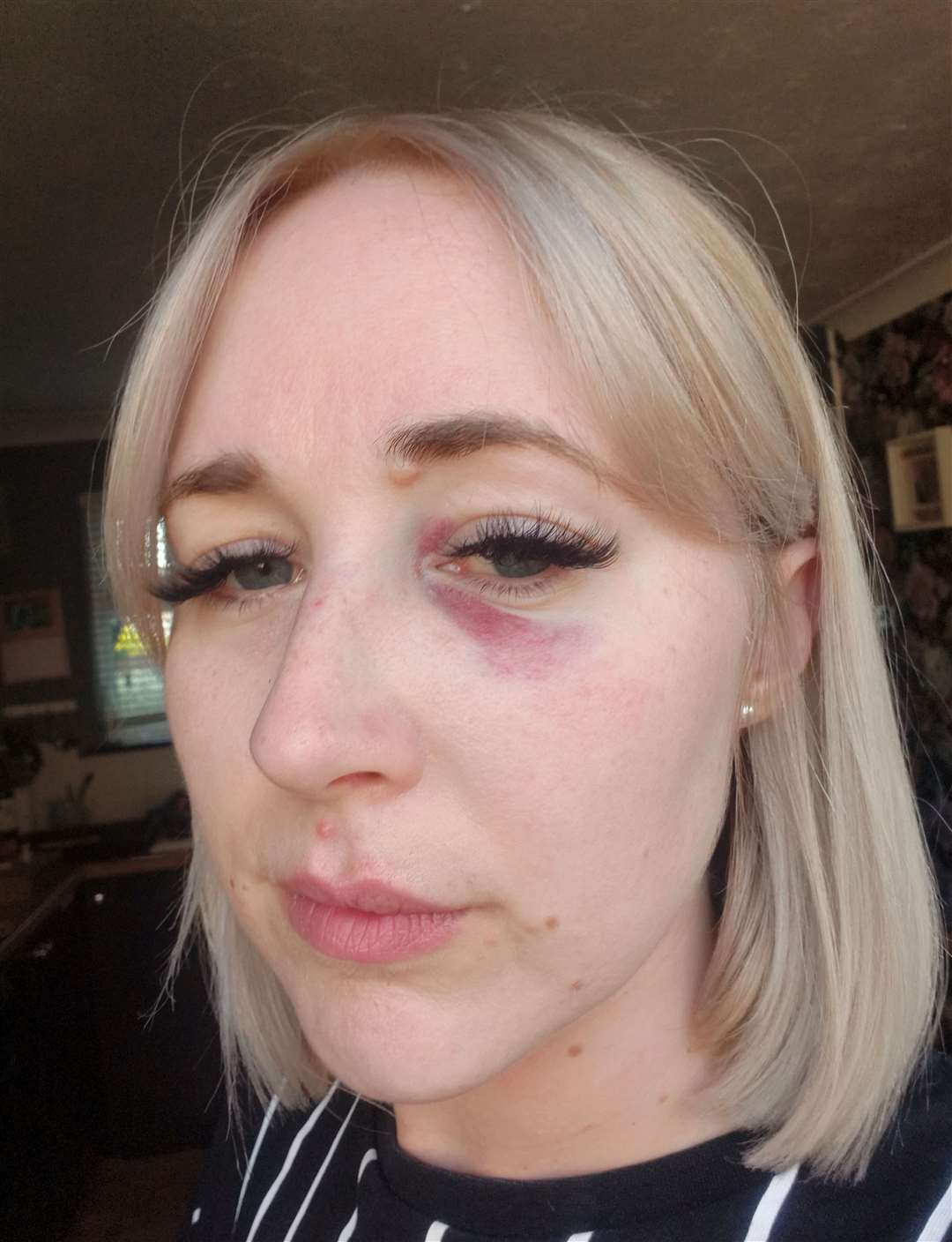 Megan Davis after being hit in the eye by a cricket ball on May 19 Submitted pictures