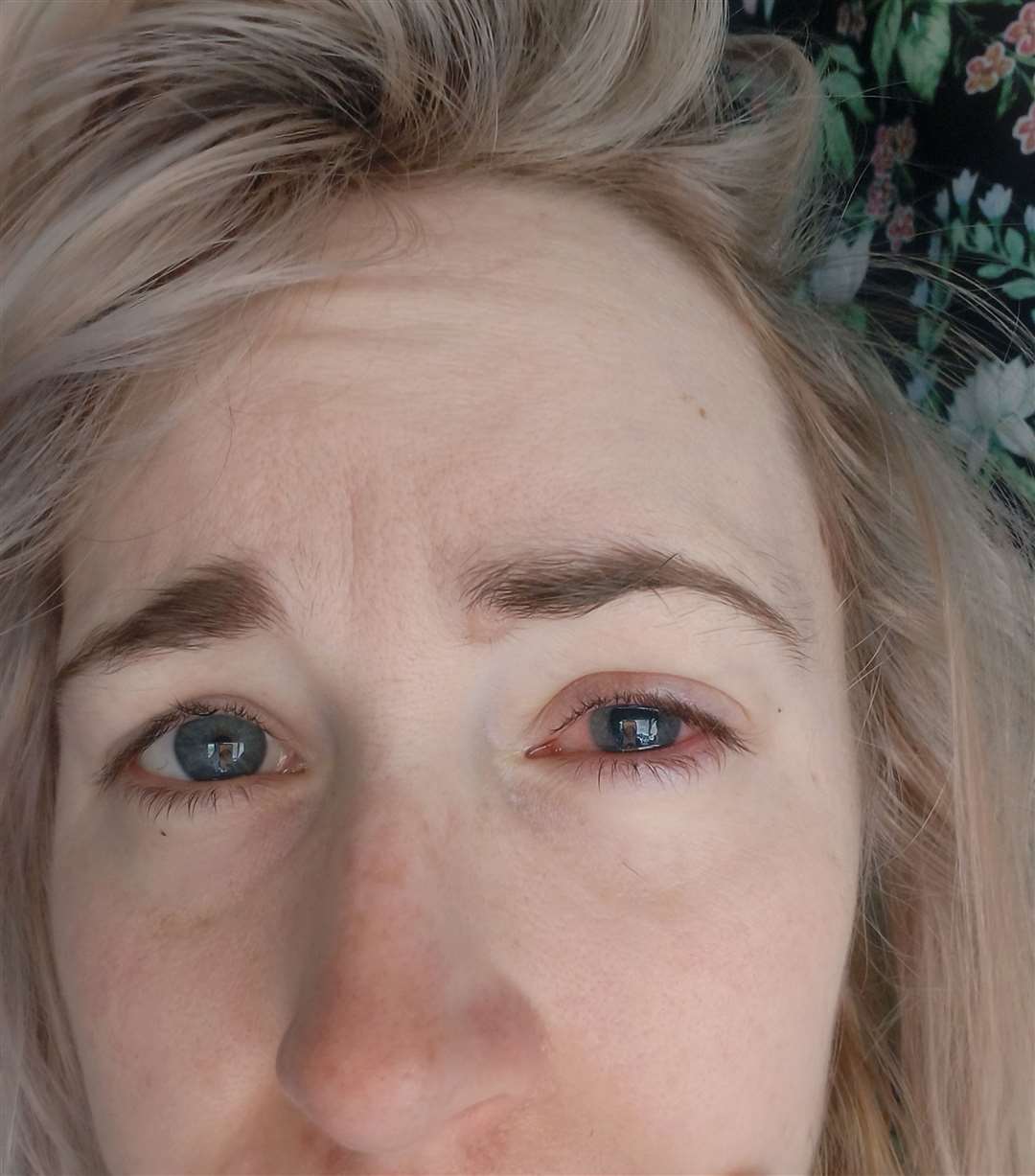 Megan Davis after her eye infection became worse.Submitted picture